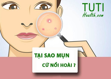 Tại sao mụn cứ nổi hoài