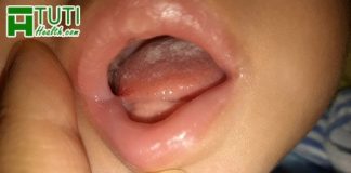 Những nguyên nhân chính khiến bé bị rộp trắng trong miệng