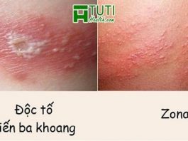 Cách phân biệt Zona và kiến ba khoang đốt