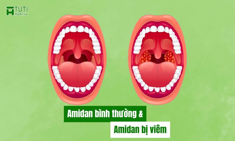 Hình ảnh Amidan bình thường và Amidan bị viêm